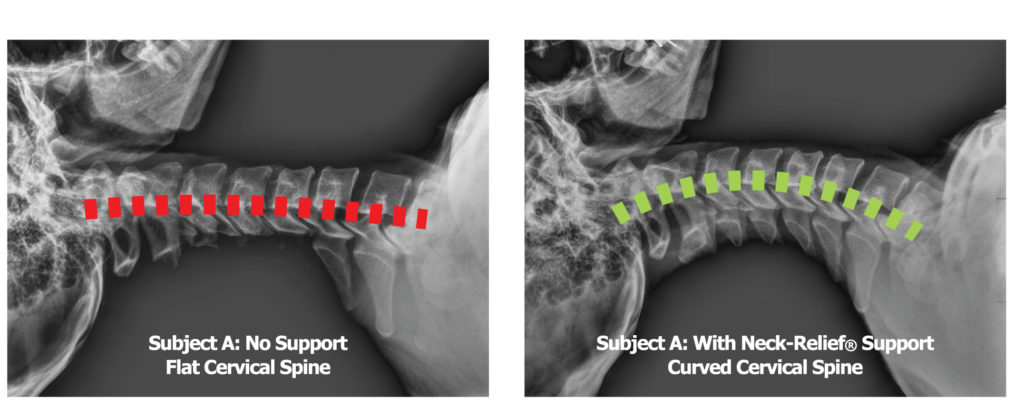 X-Ray comparison - Cervical spine with no neck support vs cervical spine using the Cervipedic Neck-Relief M2 at the highest level of support
